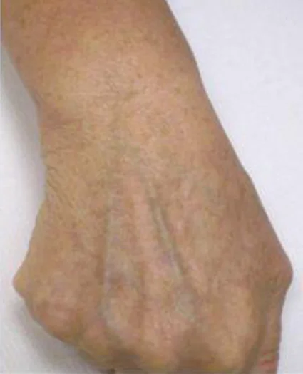 Laser & Radiofrequency after