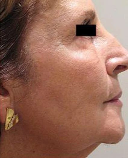 Laser & Radiofrequency after