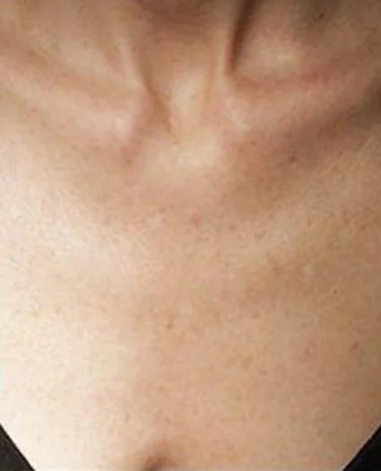 Laser & Radiofrequency after