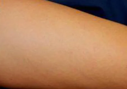 Laser & Radiofrequency after