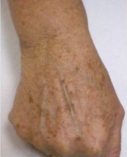 Laser & Radiofrequency before