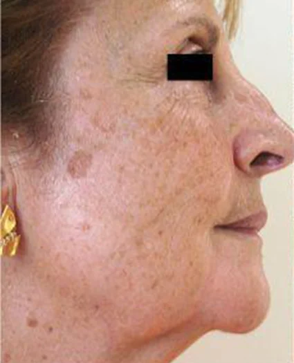 Laser & Radiofrequency before