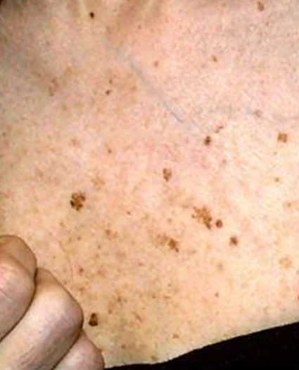 Laser & Radiofrequency before