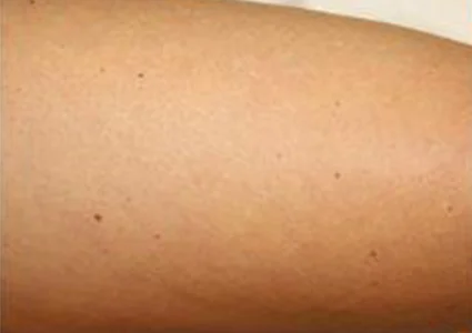 Laser & Radiofrequency before