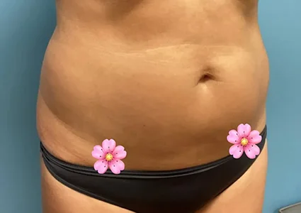 Emsculpt Neo Patient after