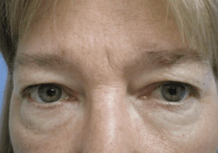 Eye-Lid-Lift-Patient before