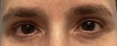 Eye-Lid-Lift-Patient-10-after