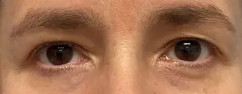 Eye-Lid-Lift-Patient-10-before