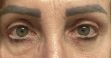 Eye Lid Lift Patient 11 After