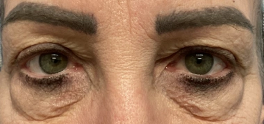 Eye Lid Lift Patient 11 Before