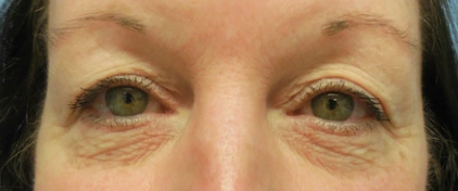 Eye Lid Lift Patient 12 Before