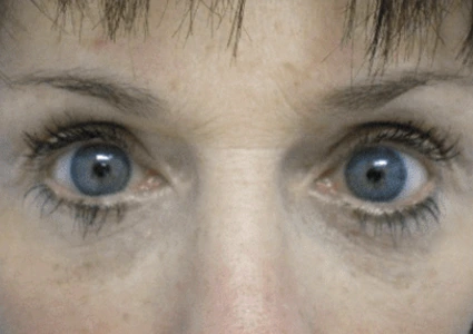 Eye-Lid-Lift-Patient after