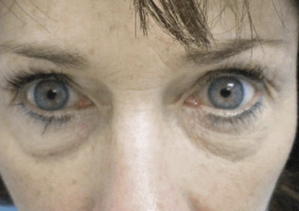 Eye-Lid-Lift-Patient before