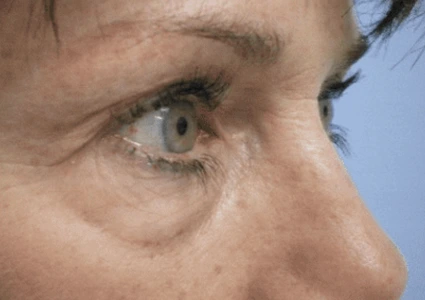 Eye-Lid-Lift-Patient before