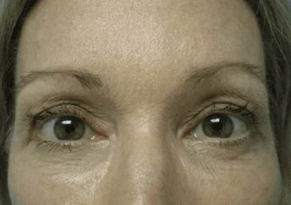 Eye Lid Lift Patient after