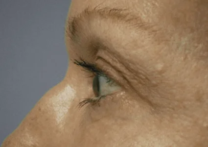 FaceTite Patient after