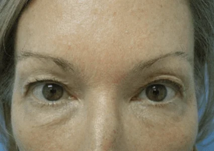 Eye Lid Lift Patient before