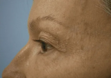 Eye-Lid-Lift-Patient before