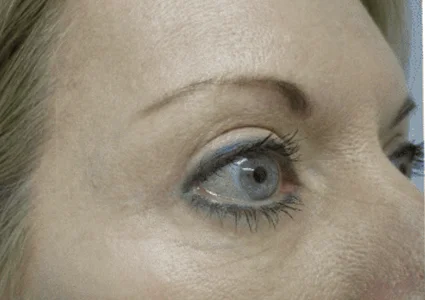 Eye Lid Lift Patient after