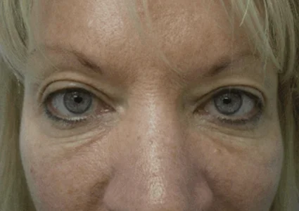 Eye Lid Lift Patient before