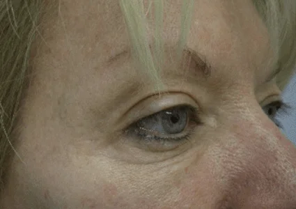 Eye Lid Lift Patient before