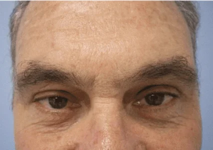 Eye Lid Lift Patient after