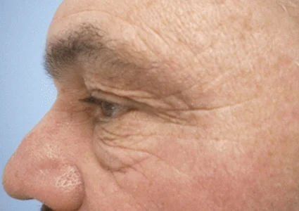 Eye Lid Lift Patient before