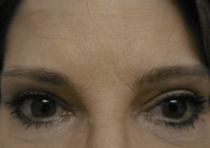 Eye Lid Lift Patient after