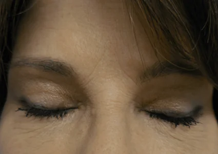 Eye Lid Lift Patient after