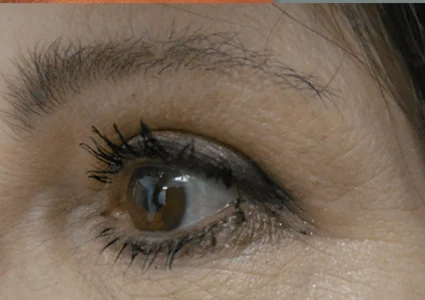 Eye Lid Lift Patient after