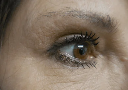 Eye Lid Lift Patient after