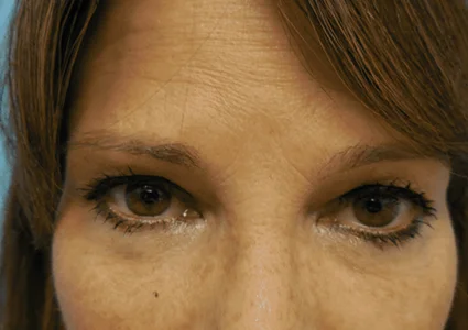 Eye Lid Lift Patient before