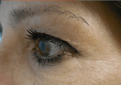 Eye Lid Lift Patient before