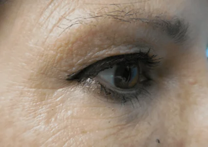 Eye Lid Lift Patient before
