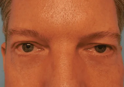 Eye Lid Lift Patient after