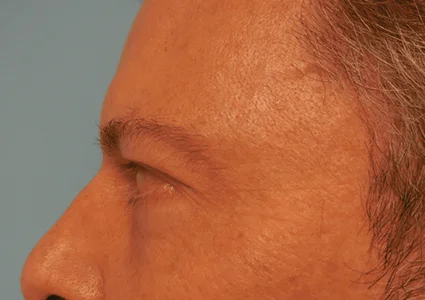 Eye Lid Lift Patient after
