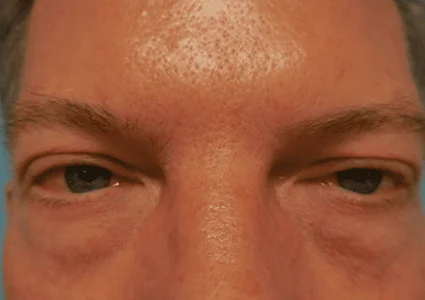 Eye Lid Lift Patient before