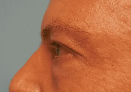 Eye Lid Lift Patient before
