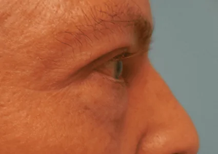 Eye Lid Lift Patient before