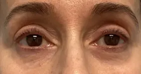 Eye-Lid-Lift-Patient-8-after