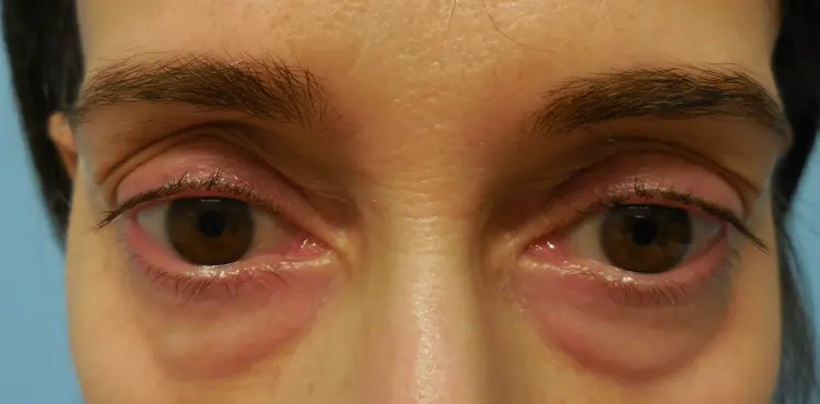 Eye-Lid-Lift-Patient-8-before