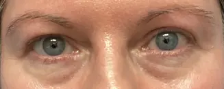Eye-Lid-Lift-Patient-9-after