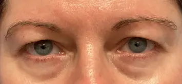 Eye-Lid-Lift-Patient-9-before