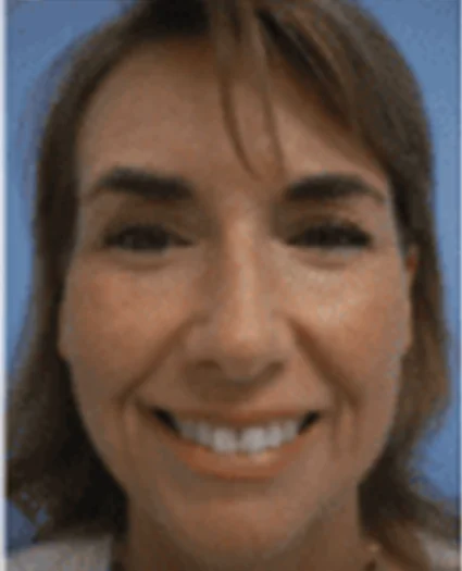 FaceTite Patient after