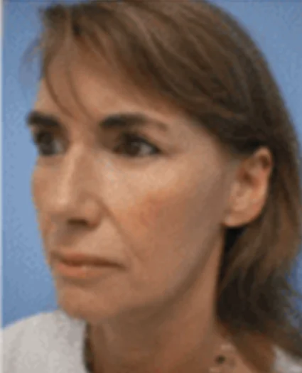 FaceTite Patient after