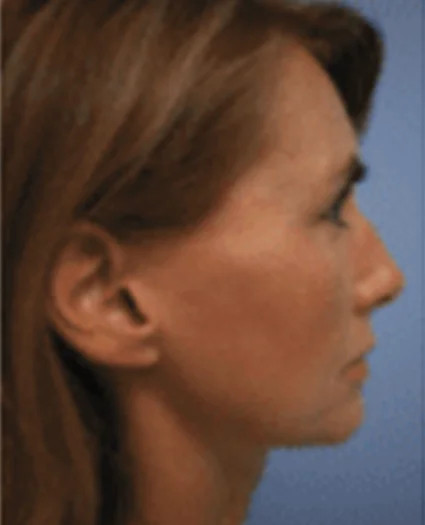 FaceTite Patient after