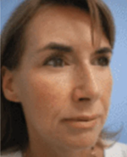 FaceTite Patient after