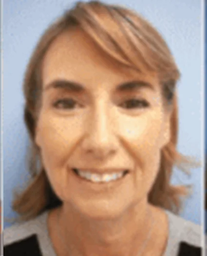 FaceTite Patient before