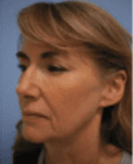 FaceTite Patient before