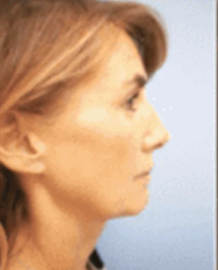 FaceTite Patient before